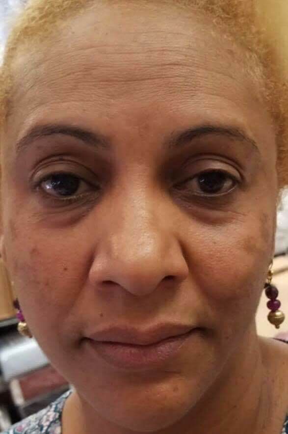 SKIN LIGHTENING TREATMENT:TRATAMIENTO EFECTIVO PARA BORRAR MANCHAS OSCURAS - Picture 8 of 10