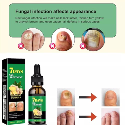 Ginger Nail Treatment Nail Care, Nail Growth Oil for Cuticle Nourishment ~~ - Picture 8 of 13