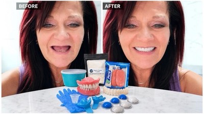 DIY Denture Kit Make Your Own Teeth At Home Complete Kit  Full Partial A1 A2 A3