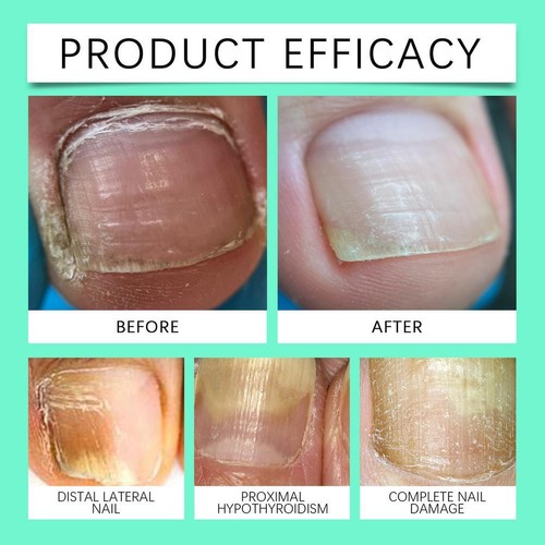 Repair Nail Pencil Repair Antibacterial Nail Pencil D1L7 - Picture 15 of 17
