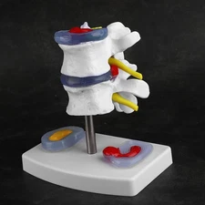 Anatomical Lumbar Disc Herniation Demonstration Model Human Spine School