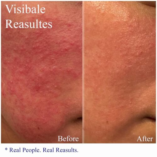 Fast-Acting Rosacea Treatment - Calming Oil-Free Moisturizer for Sensitive Skin - Picture 4 of 11