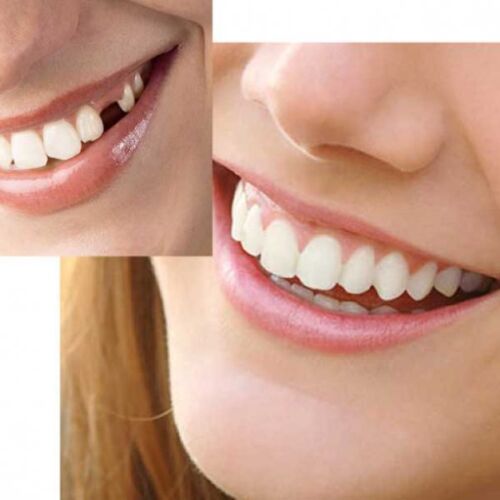 KIT DE REEMPLAZO DE DIENTES INSTANTÁNEO SMILE SELECT reparación temporal de dientes perdidos NATURAL - Imagen 5 de 6