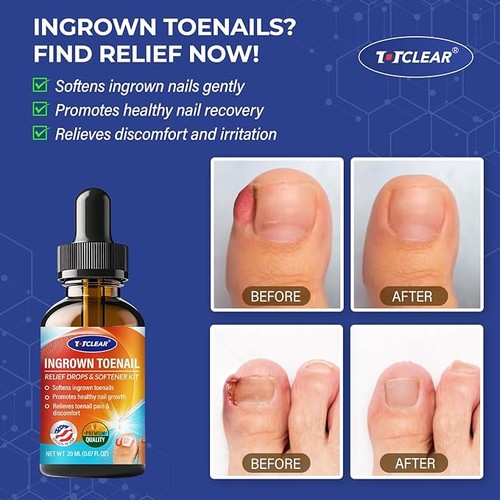 Ingrown Toenail Relief: Ingrown Toenail Tool for Men Women - Ingrown Toenail - Picture 2 of 7