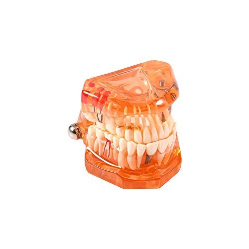 Zahnmodell Dentalmodell Entfernbares Zahn-Implantat Lehrmodell Zahnarzt Demon... - Bild 2 von 9
