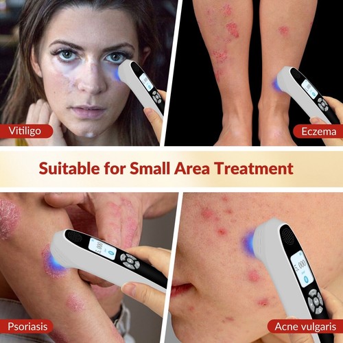 9 Diodes 55mW/cm² 308nm Excimer Skin Lightening Therapy Arm Promote Skin Repair - Picture 4 of 12