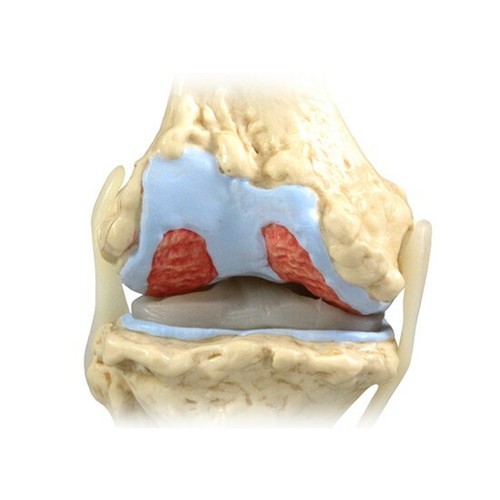 Knee 4-stage Osteoarthritis Anatomical Model LFA #1100 SEE VIDEO. Make An Offer! - Picture 2 of 4