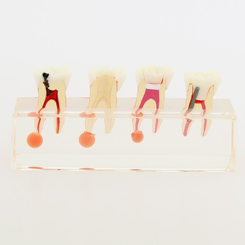 Dental Typodont Zahnmodell Implantat Pathologisch Perio Restauration Praxis Demo - Bild 116 von 312
