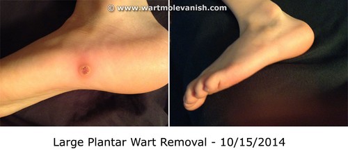 Maulwurfentferner, Warzenentferner, Hautetikettenentferner, preisgekrönter Wart Mole Vanish™ - Bild 9 von 12
