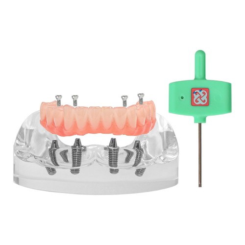 US Dental Upper/Lower 4 Implants Demo Teeth Model - Restoration Overdenture - Picture 35 of 47