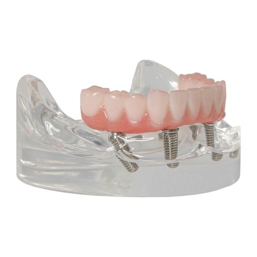 US Dental Upper/Lower 4 Implants Demo Teeth Model - Restoration Overdenture - Picture 40 of 47