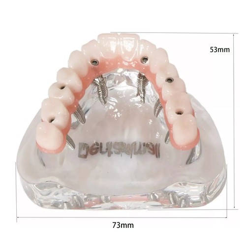 Dental Implant Modle Overdenture treatment Restoration Model U/L Jaw 4/6 Screws - Picture 39 of 65