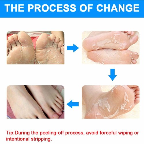 Foot Peel Mask for Baby Soft Feet,Exfoliating Foot Mask for Dead Skin & Callus - Picture 5 of 7