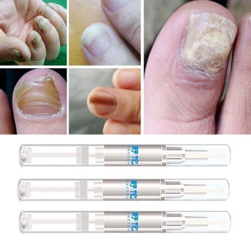 3ML Pilz Nagel Behandlung Liquid Pen Nagel Finger Zehe Repair Remover 2025HOT - Picture 14 of 14