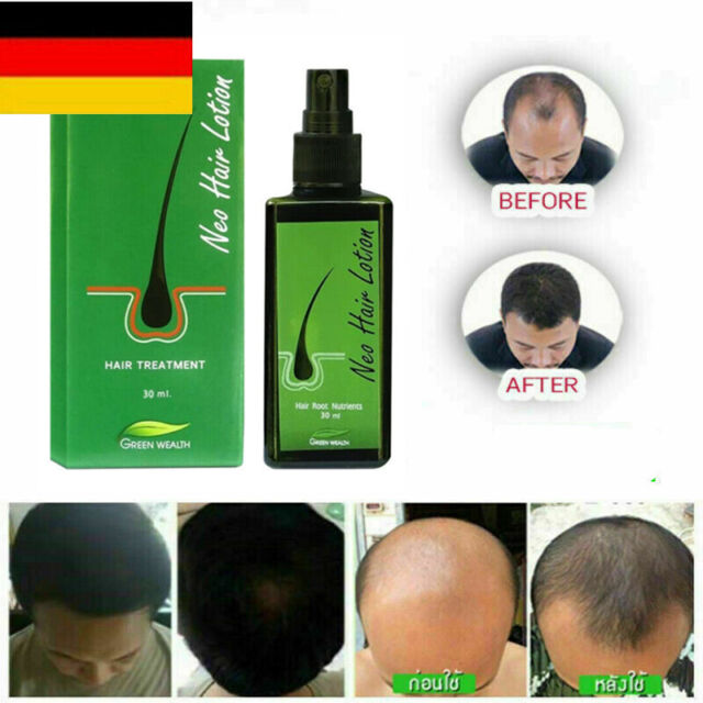 NEO Hair Regrowth Lotion Haarpflege / Haarausfall / Kahlheit Behandlung 30ml DE NC11483 NEO Hair Regrowth Lotion Haarpflege / Haarausfall / Kahlheit Behandlung 30ml DE NC11483