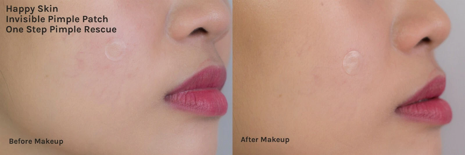 ACNE STUDIOS MEDIHEAL A zero Shot Patch Macchia Idrocolloide 80+Toppa Vestibilità 80 K Beauty Corea