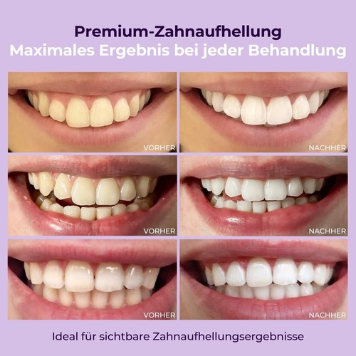 3er-Pack Bleaching Gel für Weiße Zähne | Testsieger 2024-2025 | 9+ Nuancen in... - Bild 3 von 8