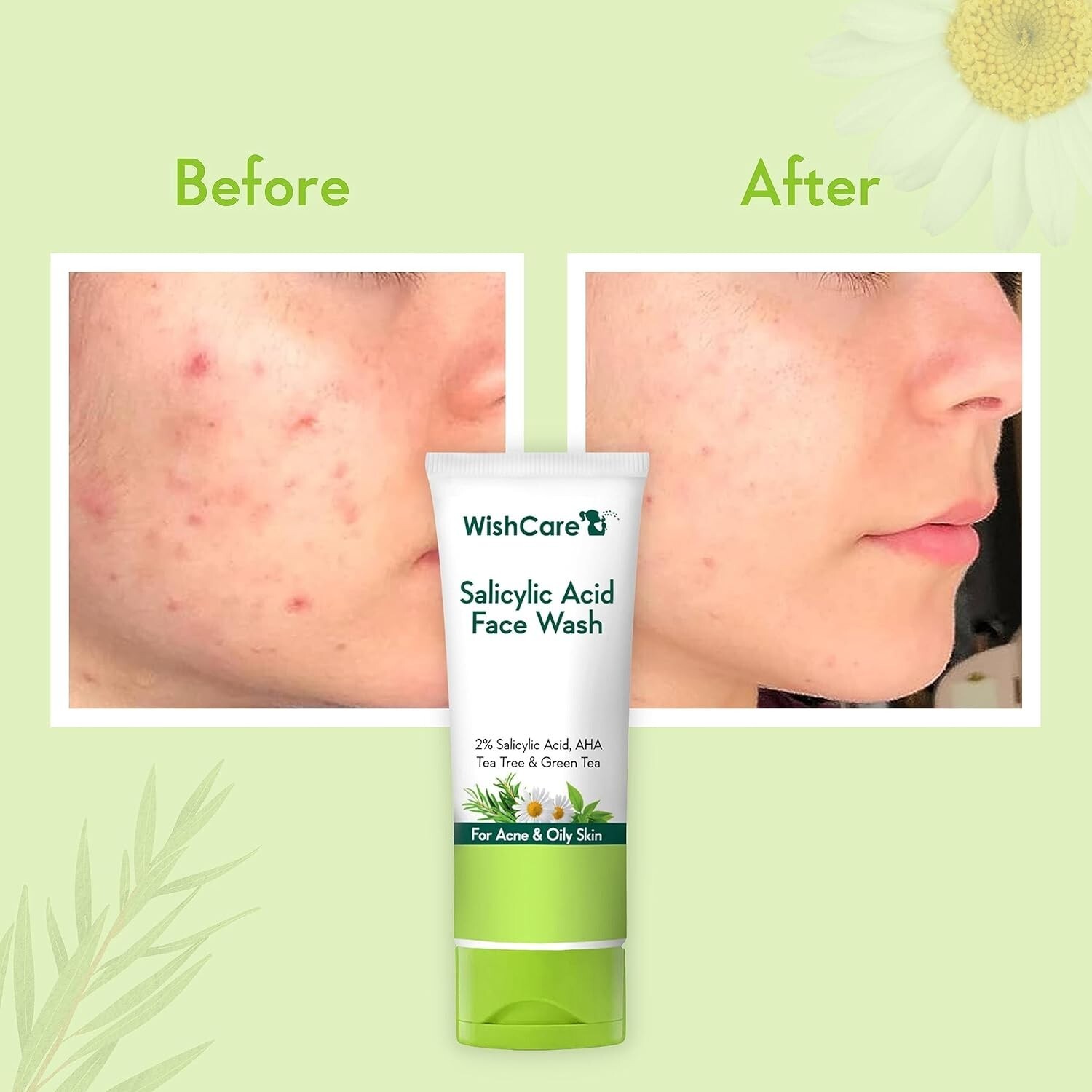 WishCare 2% Salicylic Acid Face Wash best effect  Acne Control 100 gm