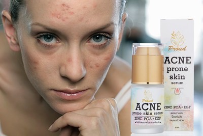 acne ser