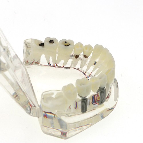 Modelo de implante y restauración de tipodonte dental modelo de demostración práctica de dientes modelo de tipodonte - Imagen 16 de 61