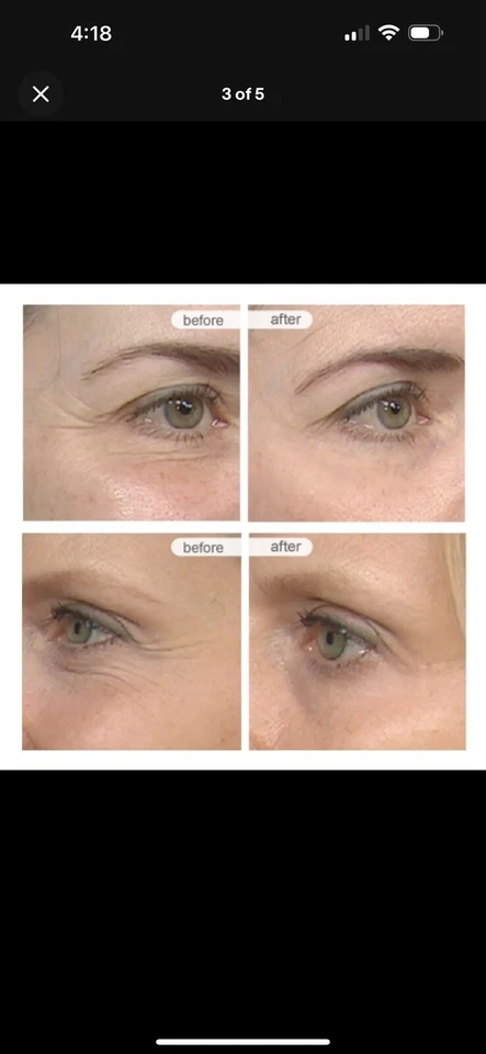 SORO Matrixyl 3000, 20% Argireline, vitamina C peptídeo ácido hialurônico rugas - - Imagem 3 de 3