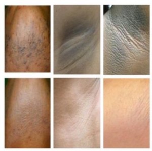 skin bleaching cream for black skin