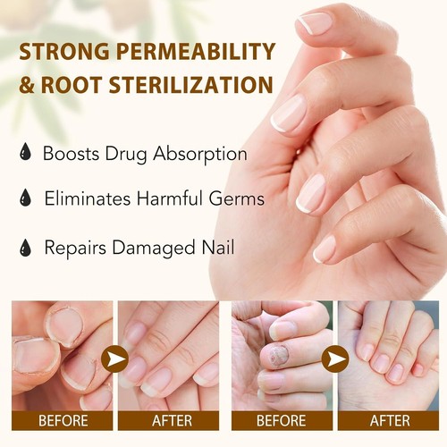 7-Day Toenail Fungus Treatment – Extra Strength Repair for Discolored Nails 60ML - Picture 5 of 6