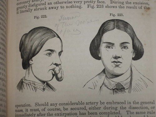 1859 SYSTEM OF SURGERY- VOL. 1 SAMUAEL GROSS / ILLUSTRATED, LEATHER - Picture 12 of 12
