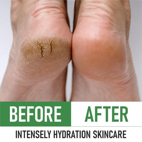 Urea 40% Foot Cream - Made in USA - Callus Remover - Moisturizes & Rehydrates... - Picture 7 of 7