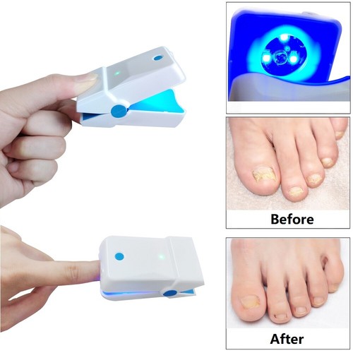 Anti Fungal Laser Therapy Device Finger Toe Nail Fungus Remover Onychomycosis - Picture 10 of 10