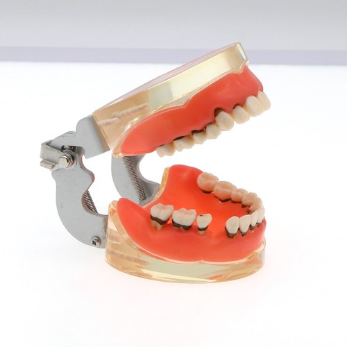 Dental Typodont Zahnmodell Implantat Pathologisch Perio Restauration Praxis Demo - Bild 108 von 312