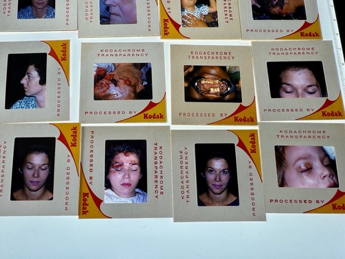 20 DIAPOSITIVAS COLOR CIRUGÍA ESTÉTICA MÉDICA EXTRAÑA VINTAGE AÑOS 60 - Imagen 4 de 6