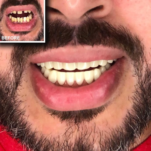 Complete Smile Makeover Kit - Upper & Lower Veneers - Picture 7 of 7