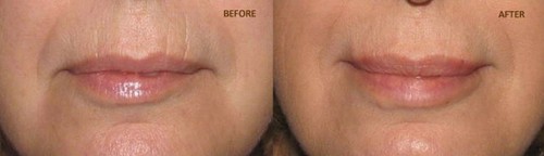 10 ML -UPPER LIP PLUMPER COMPLEX OIL - LIP PERIORAL AREA - Picture 4 of 4