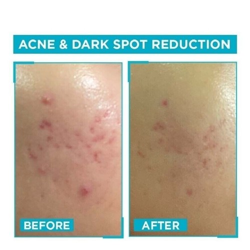 2X Garnier (2027) Skin Natural Bright Complete Anti-Acne Booster Serum 30ml - Picture 4 of 5