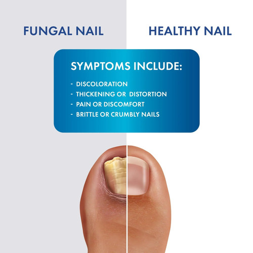 ProClearz Pilzschutz - Maximale Stärke Antimykotikum Brush-On Flüssigkeit, 1 Oz. - Bild 3 von 3
