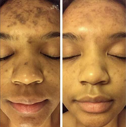 ADMIRE MY SKIN BRIGHTENING SERUM Whitening Lightening Dark Spot Bleaching Cream - Picture 11 of 12