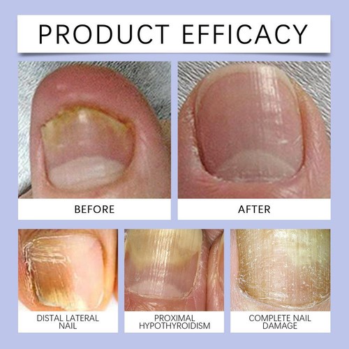 Fungal Nail Treatment Strong Fungus Remover Antifungal Liquid Serum Paronychia ≥ - Picture 15 of 18