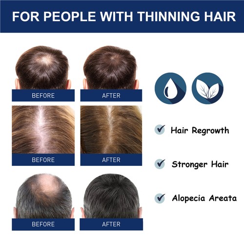 Crema Crescita Capelli 20g per Ricrescita Capelli Più Forte Alopecia Areata - Foto 6 di 12