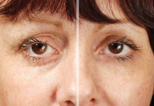 RX Flawless Eyes - BUY ONE GET ONE ABSOLUTELY FREE (2 X 10ML BOTTLES) £26.99 - Picture 4 of 9