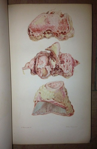 1865 Peter Charles PRICE DESCRIPTION DISEASED CONDITIONS OF THE KNEE-JOINT E.O. - Picture 5 of 12