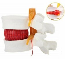 Human Lumbar Vertebrae Degenerative Disc Disease Anatomical Model White US STOCK