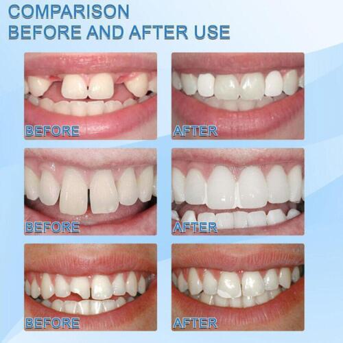 Strong Tooth Repair Permanent Dental Cement Cavity Best Filling Tooth Kit V6R5 - Picture 6 of 12