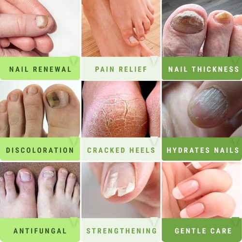 CLEAR Urea Nail Gel w/Tea Tree Oil-Softens Hydrates & Repairs Nails Fast Result - Picture 3 of 6