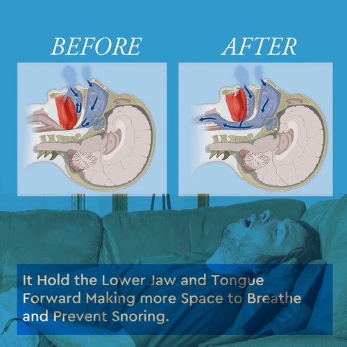 Anti Snore Mouthpiece Sleep Aids Mouth Guards Stop Snoring Adjustable Bruxisms - Picture 6 of 15
