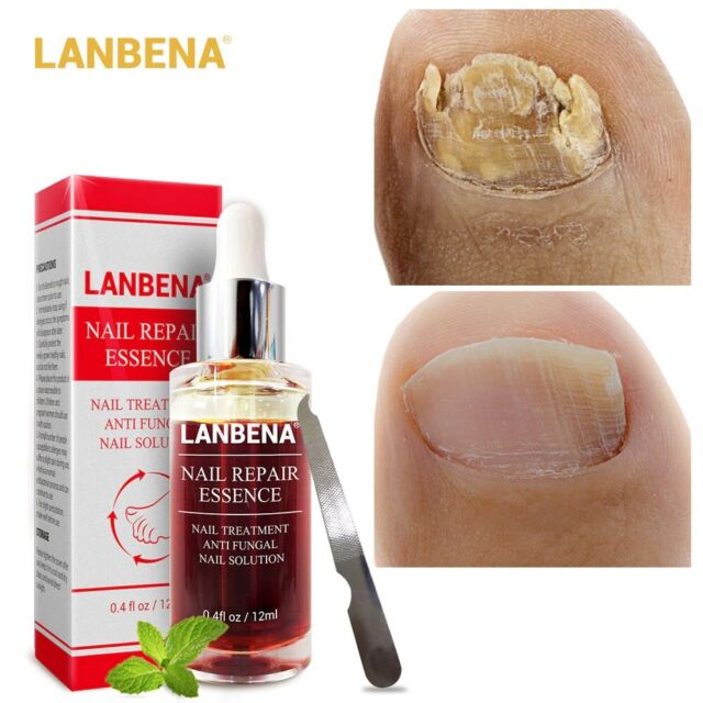 Regeneration Toe Nail Fungus Treatment Cream Onychomycosis Infection Care For Sale Online Ebay