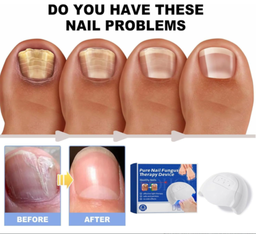 Furzero Purenail Fungus Laser Therapy Device, Light Therapy Device Fungal Nail - Picture 1 of 8