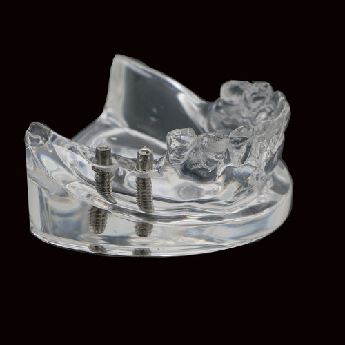 Modelo de reparación de implantes dentales prótesis parciales removibles modelo Typodont transparente - Imagen 8 de 13