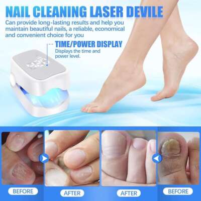 Laser Nagelpilz Fungal Nail Therapie Lasergerät Fungus Lazer Heimgebrauch DE
