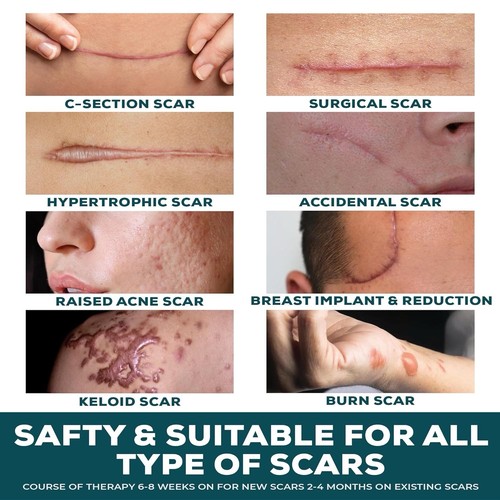 Silicone Scar Sheets Tape Roll Reusable Strips Surgical Keloid Scars 1.6”x79” 2M - Picture 4 of 9